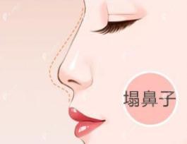 鼻子塌